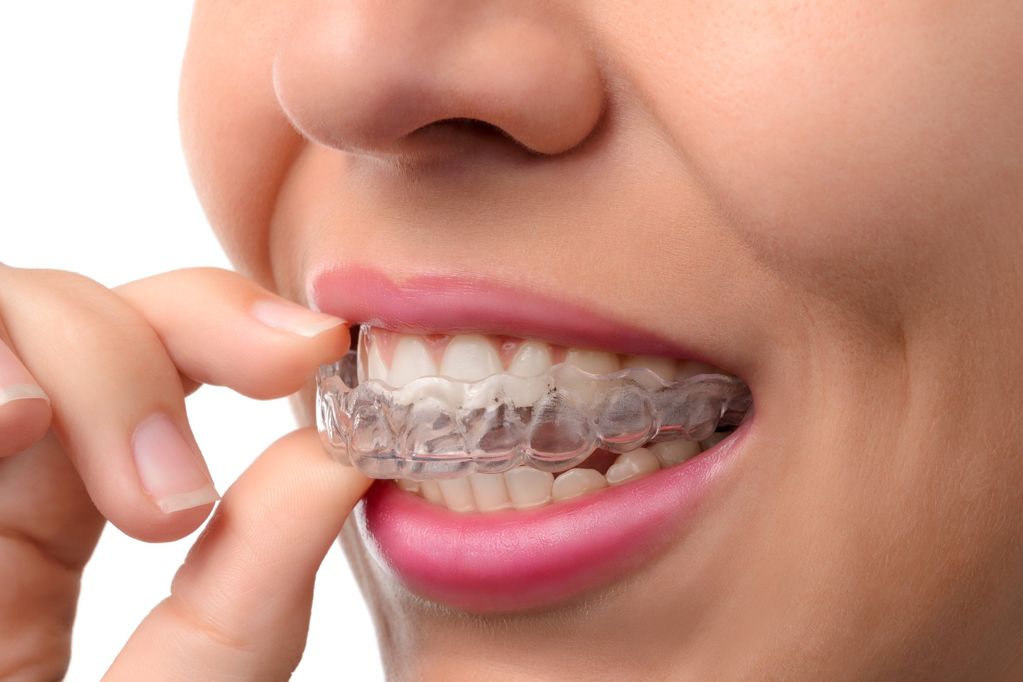 woman with Invisalign