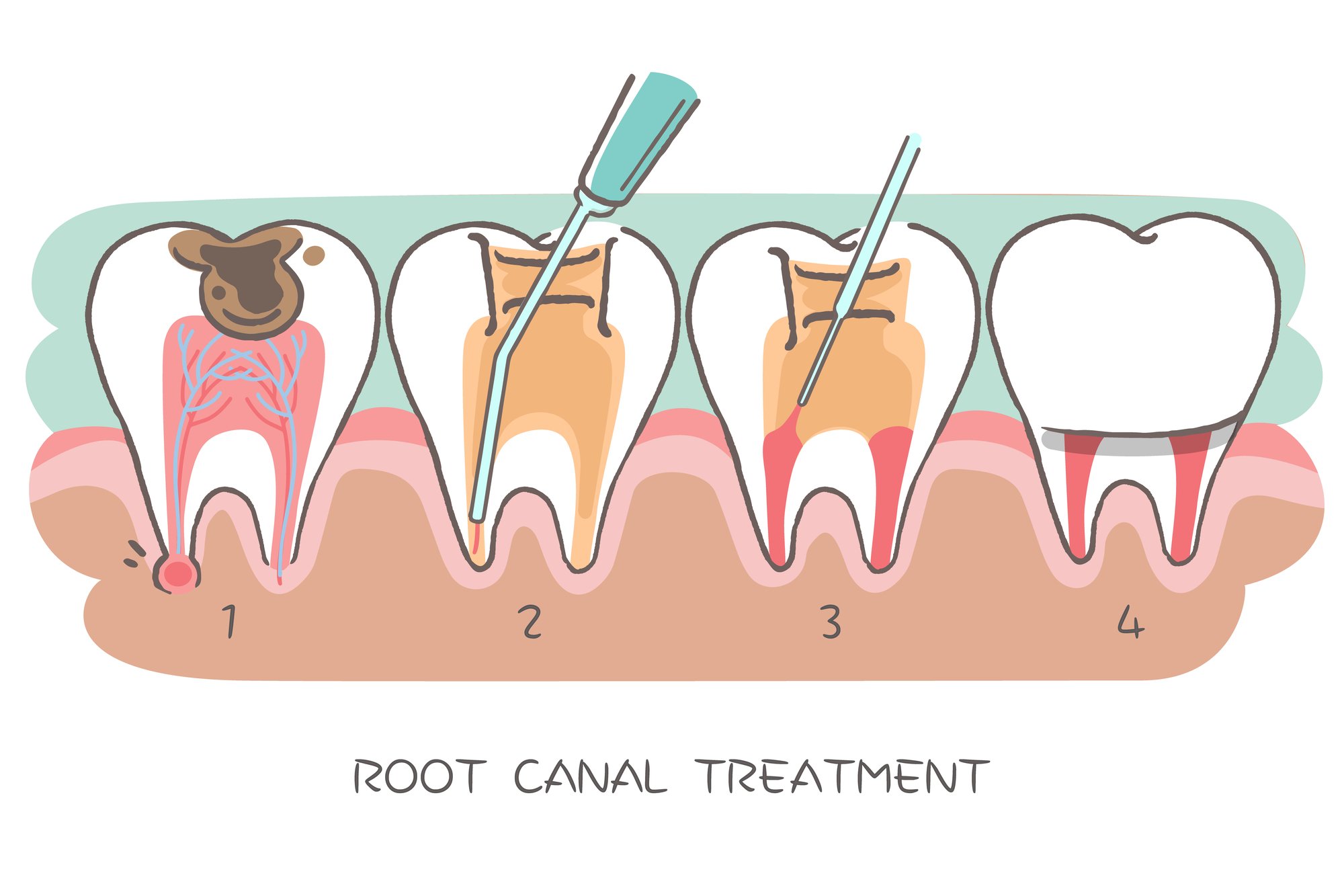illustration of root canal therapy