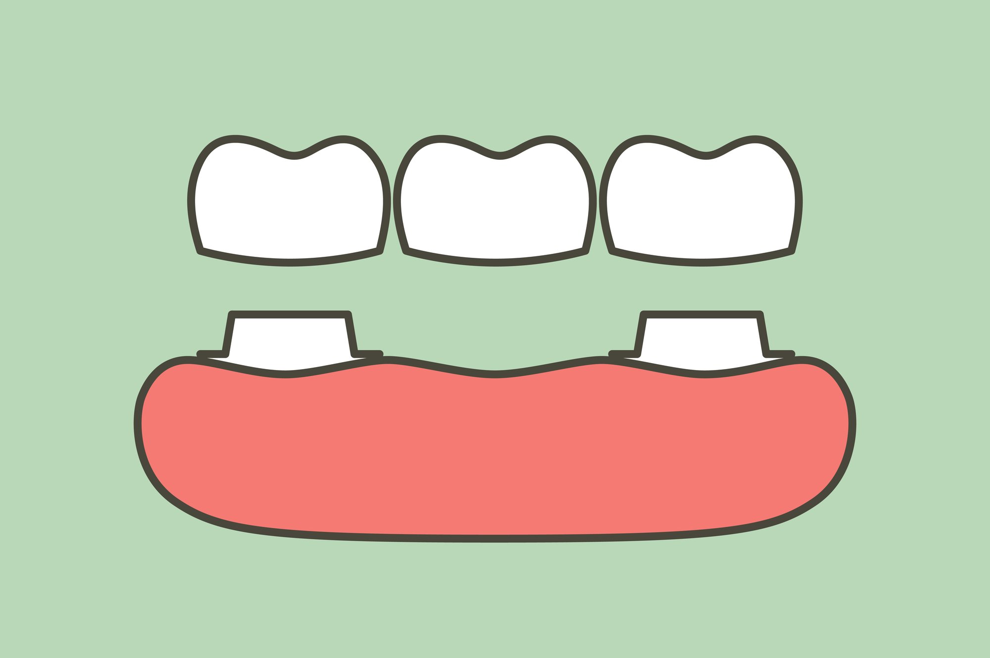 dental bridge illustration