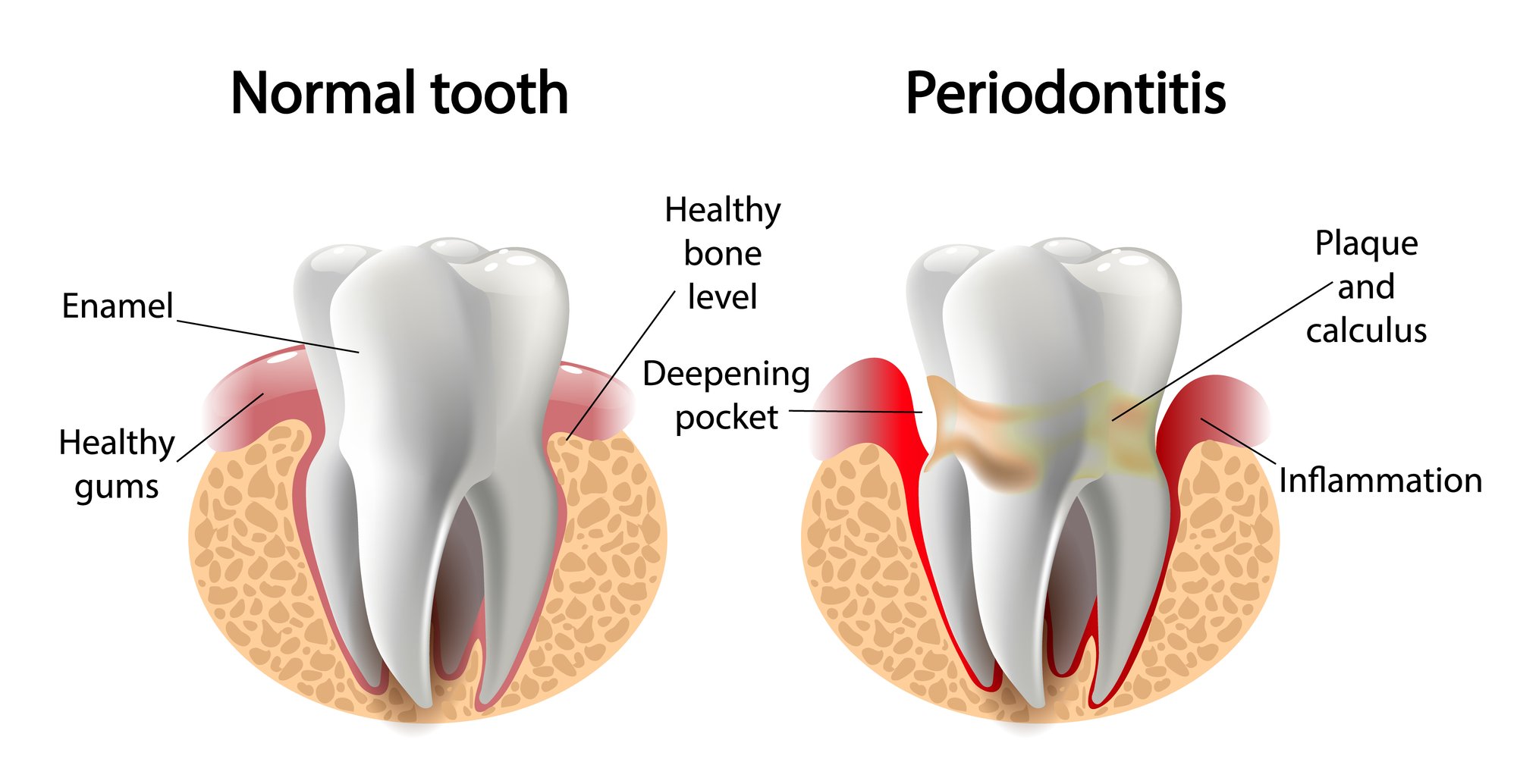 illustration depicting periodontitis