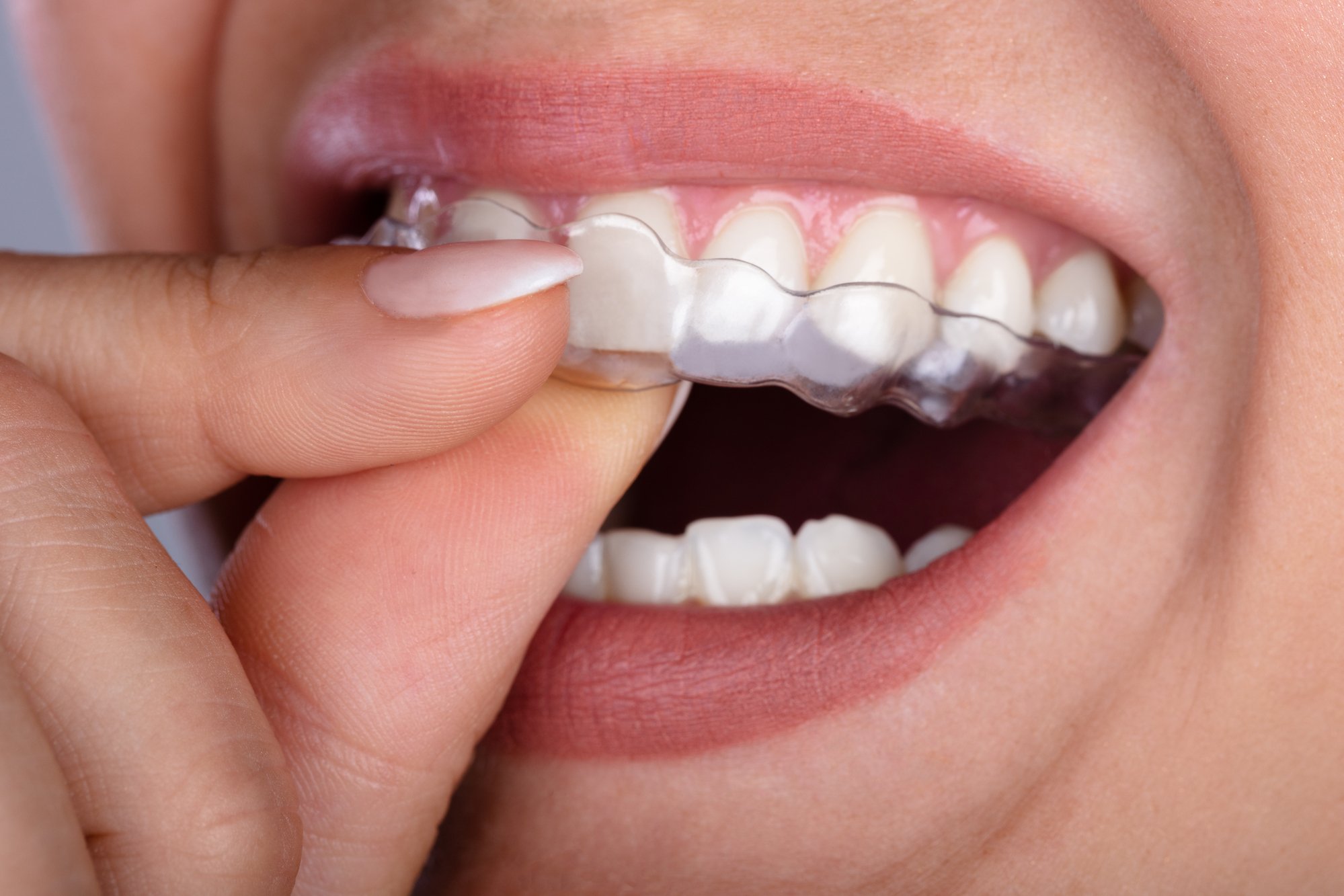 woman placing Invisalign aligners in mouth