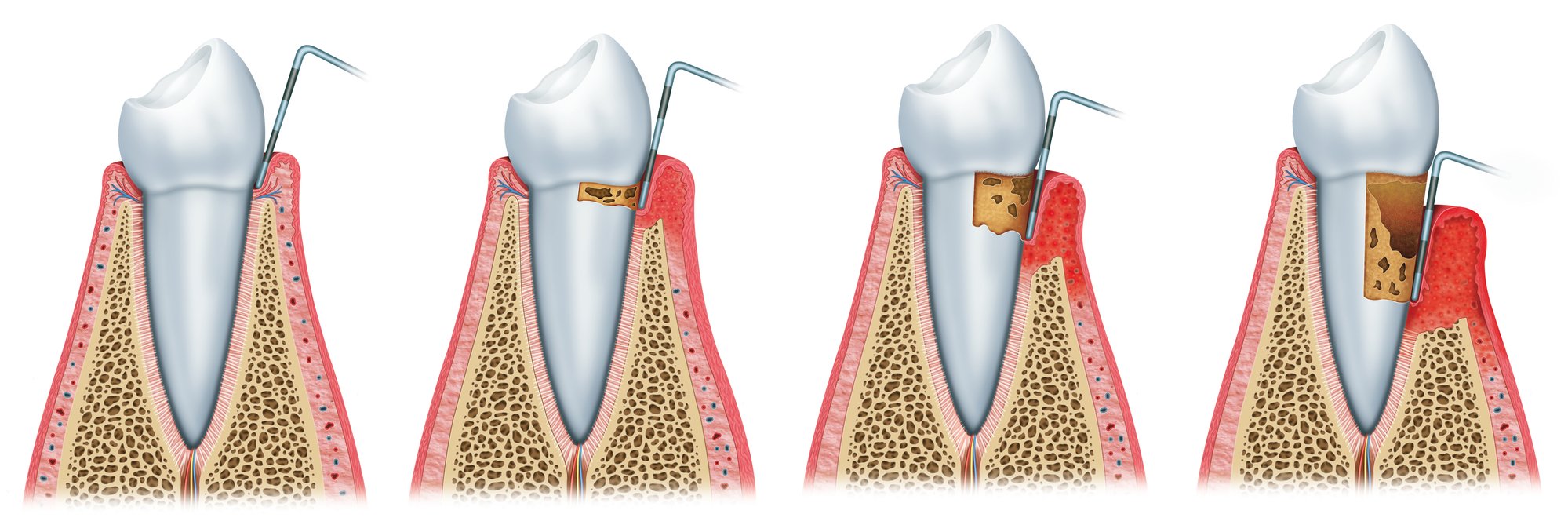 chart with progression of periodontal disease