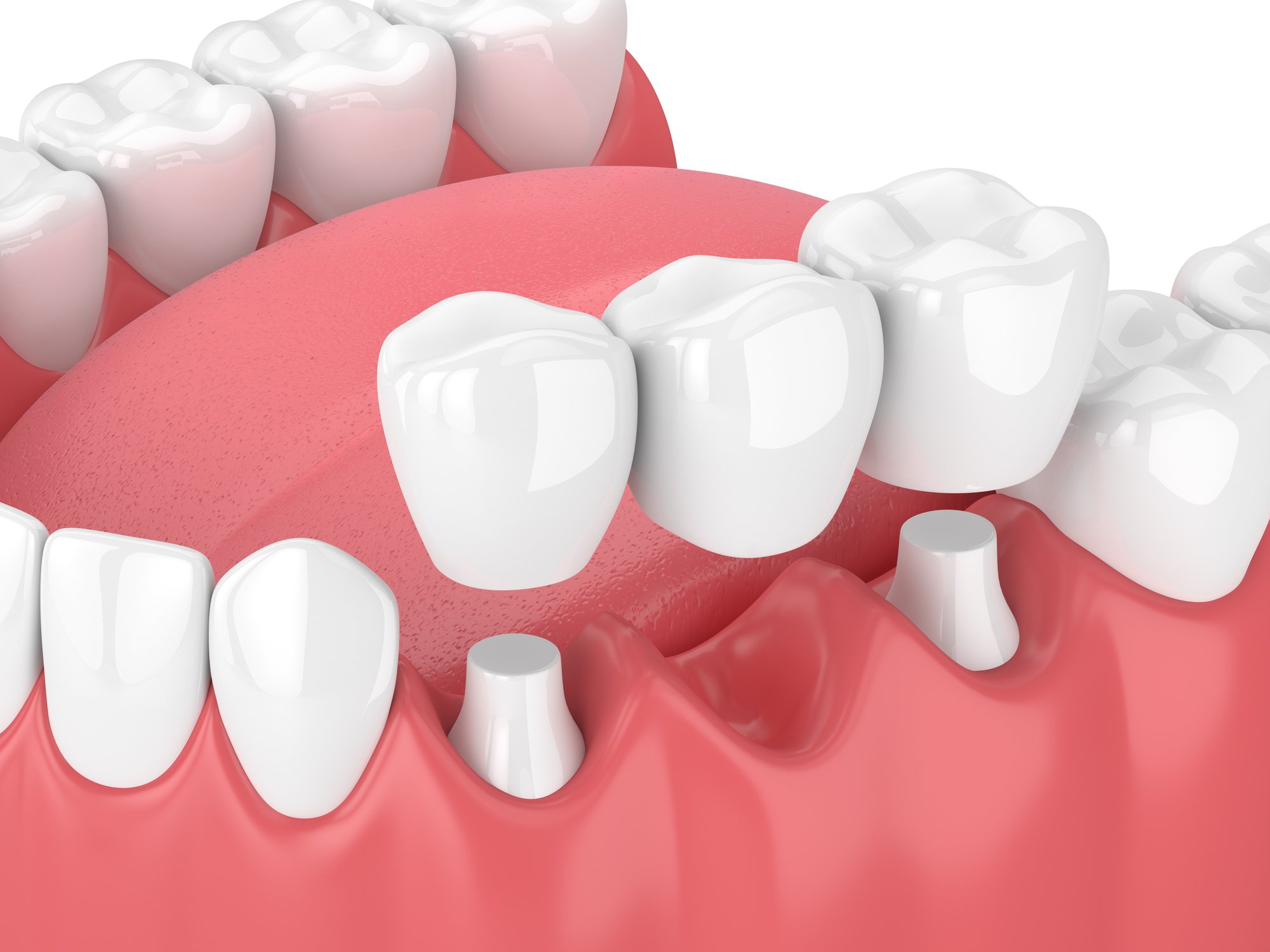 3d render of jaw with a dental bridge