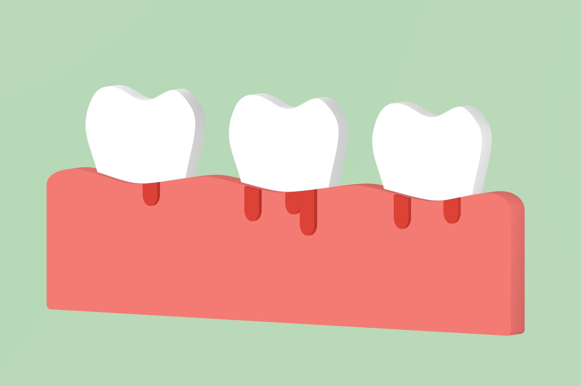 gum disease or periodontal disease on green background
