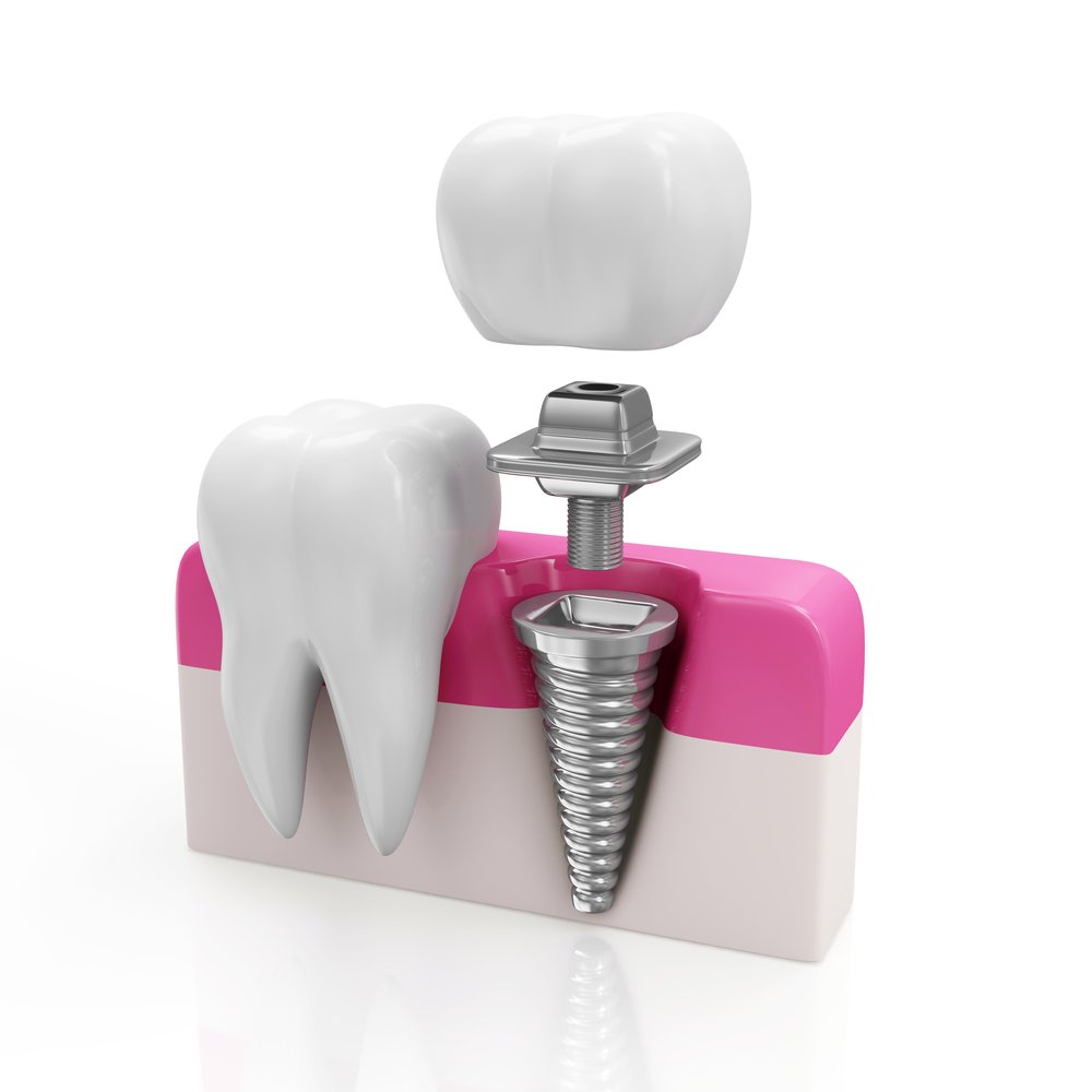 coffs implant dentist