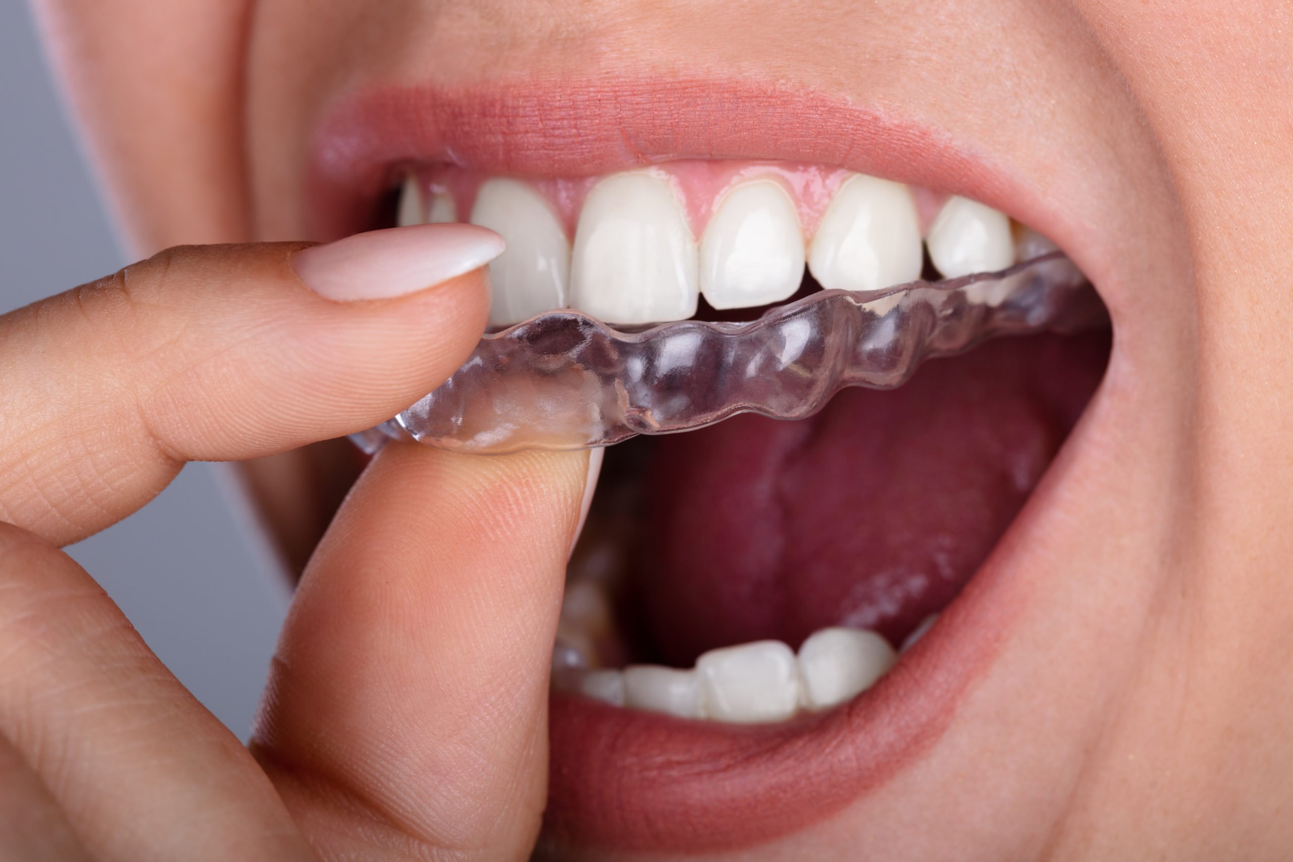 A woman puts a clear aligner in her mouth after visiting an Invisalign doctor in New South Wales.