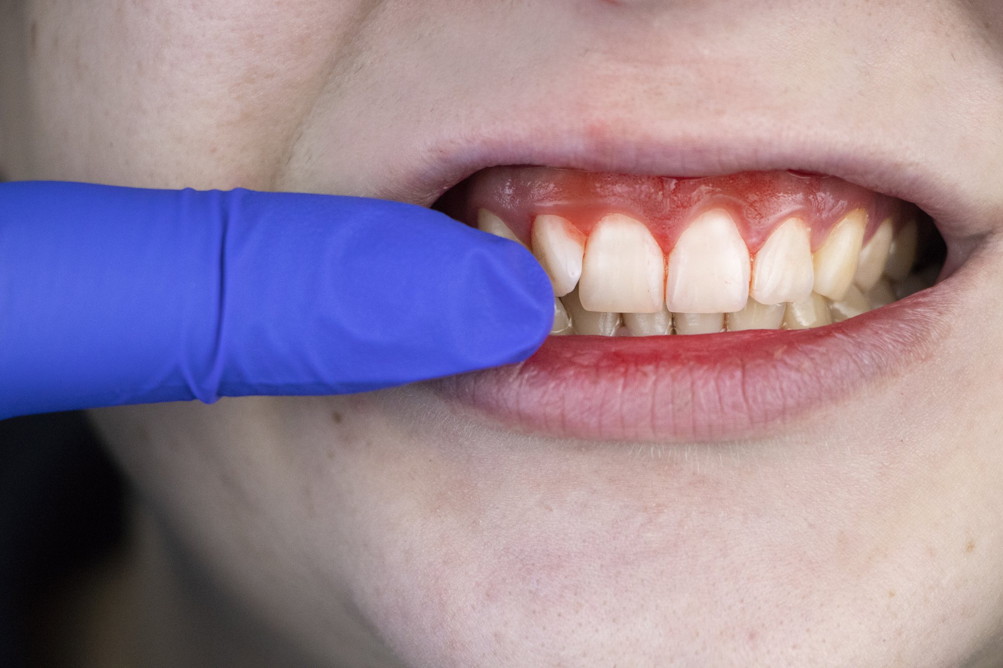 Image of bleeding and inflamed gums from gum disease