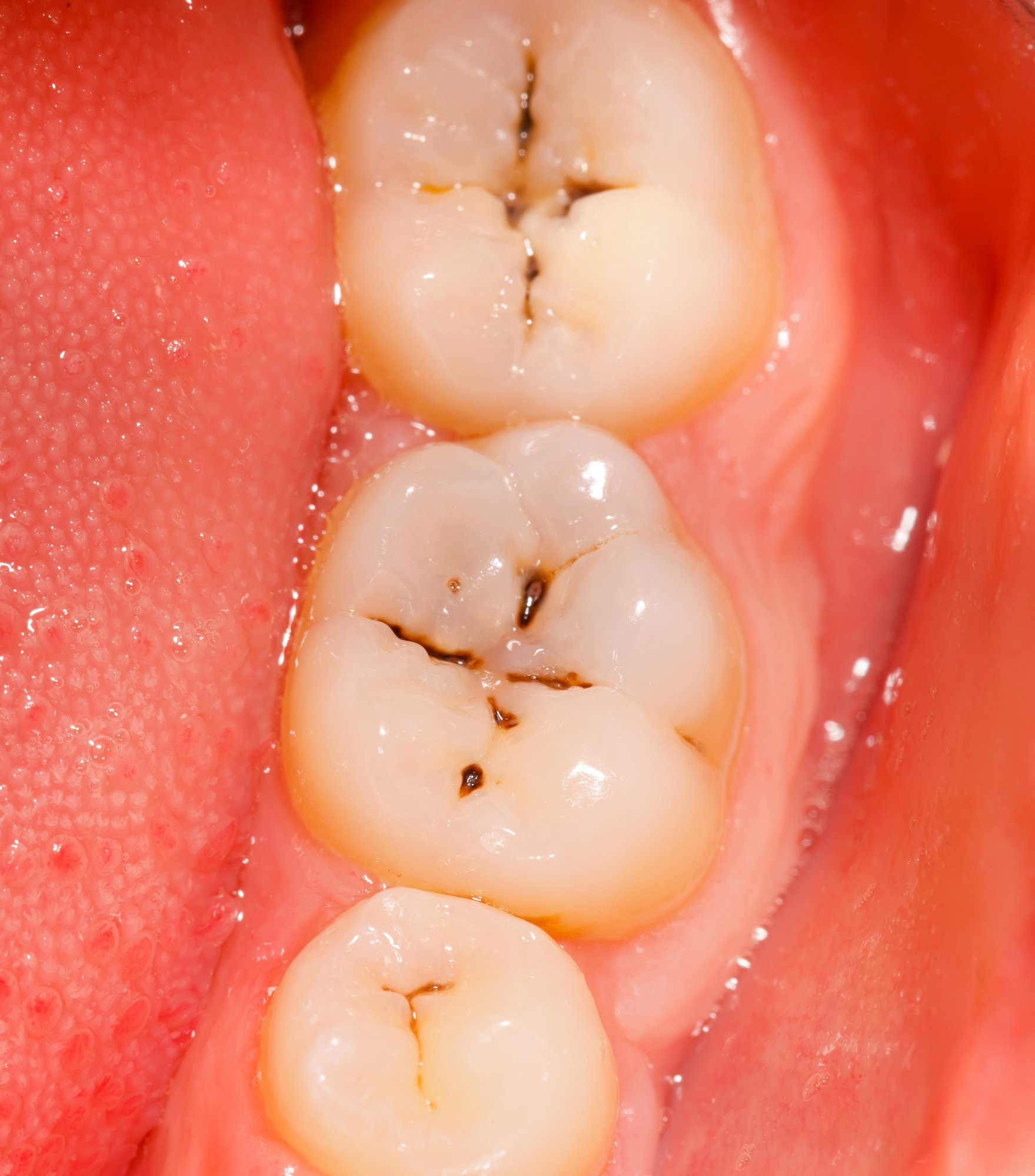 image of small holes and stains in teeth which are cavities symptoms