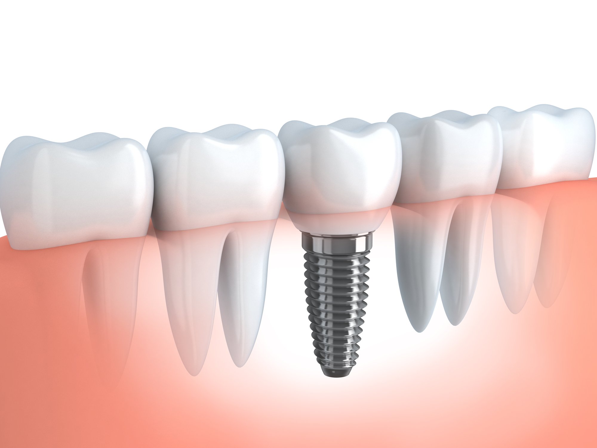 3D graphic of dental implant