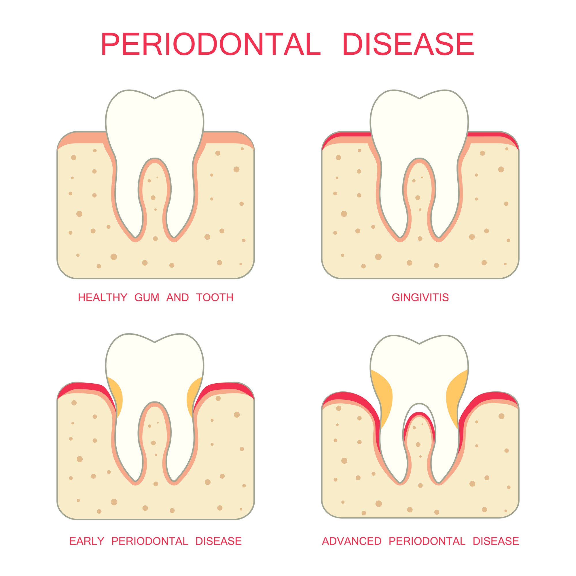 graphic of the stages of periodontal disease
