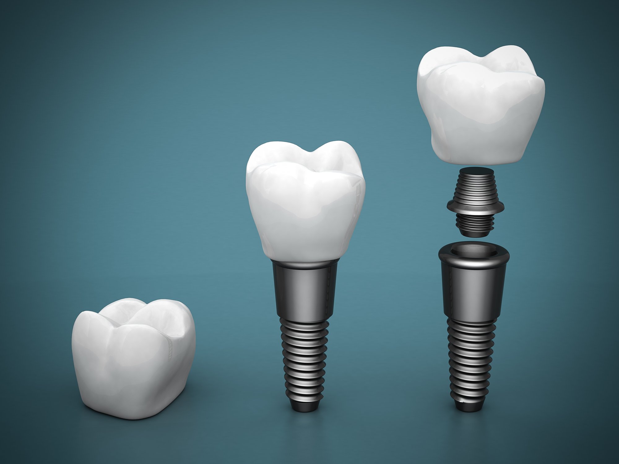 3D illustration of how crowns for teeth sit on a dental implant