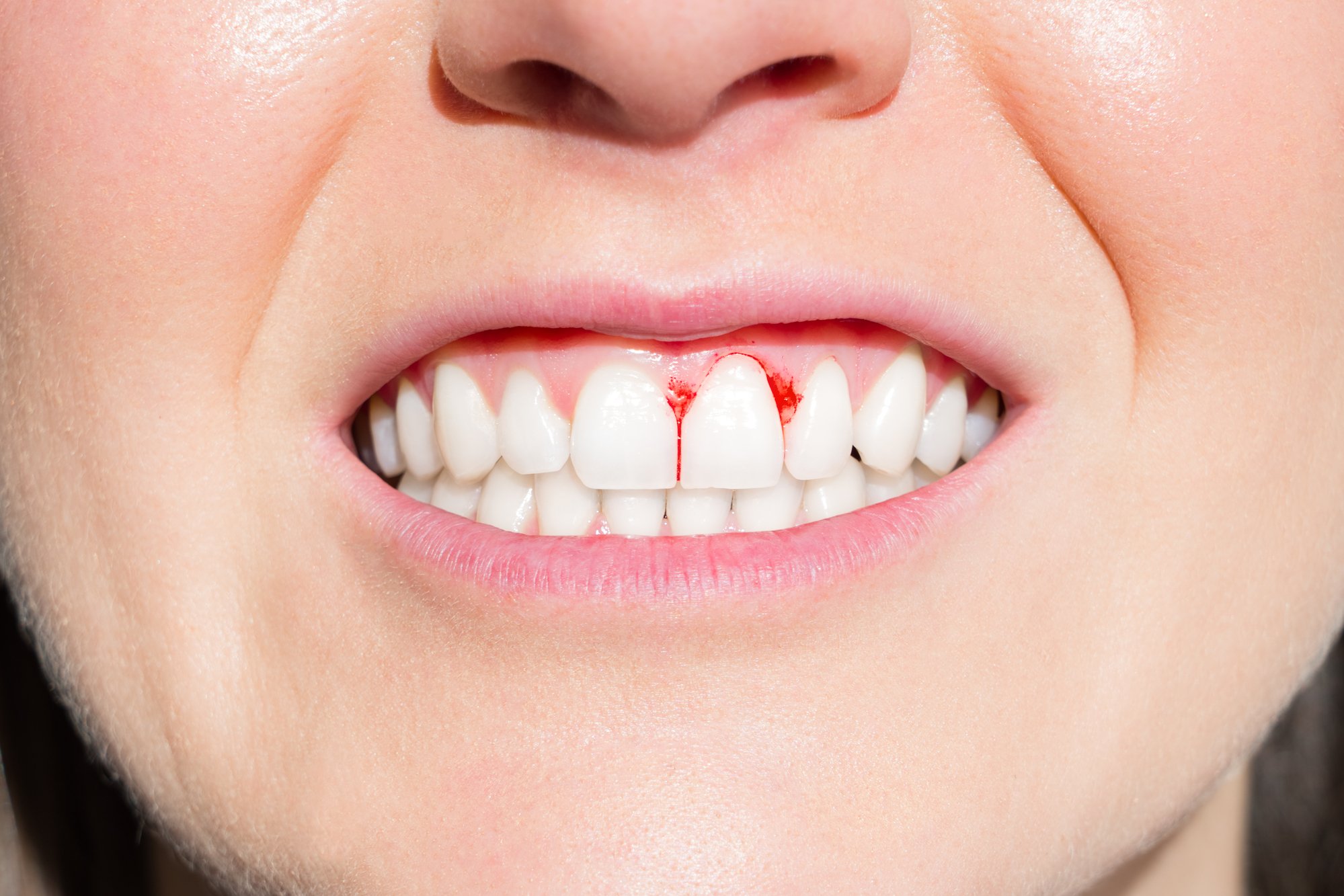 Close up of woman mouth with red gums