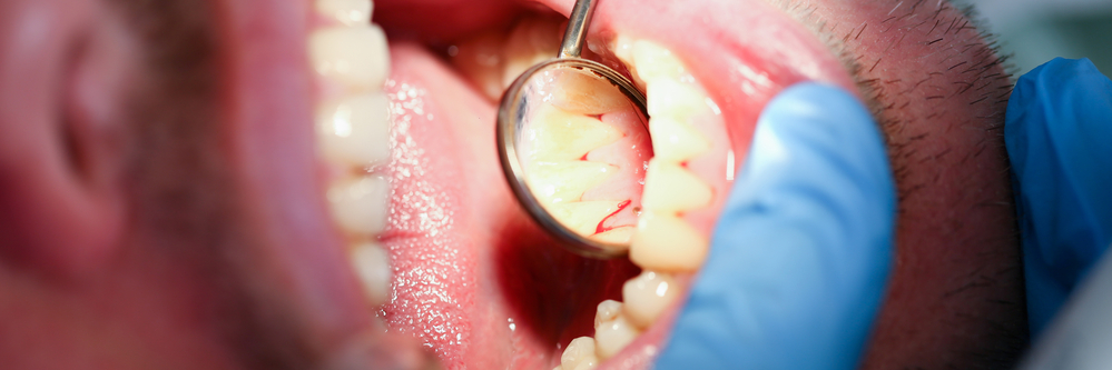 dental hygienist identifies bleeding gums in patient
