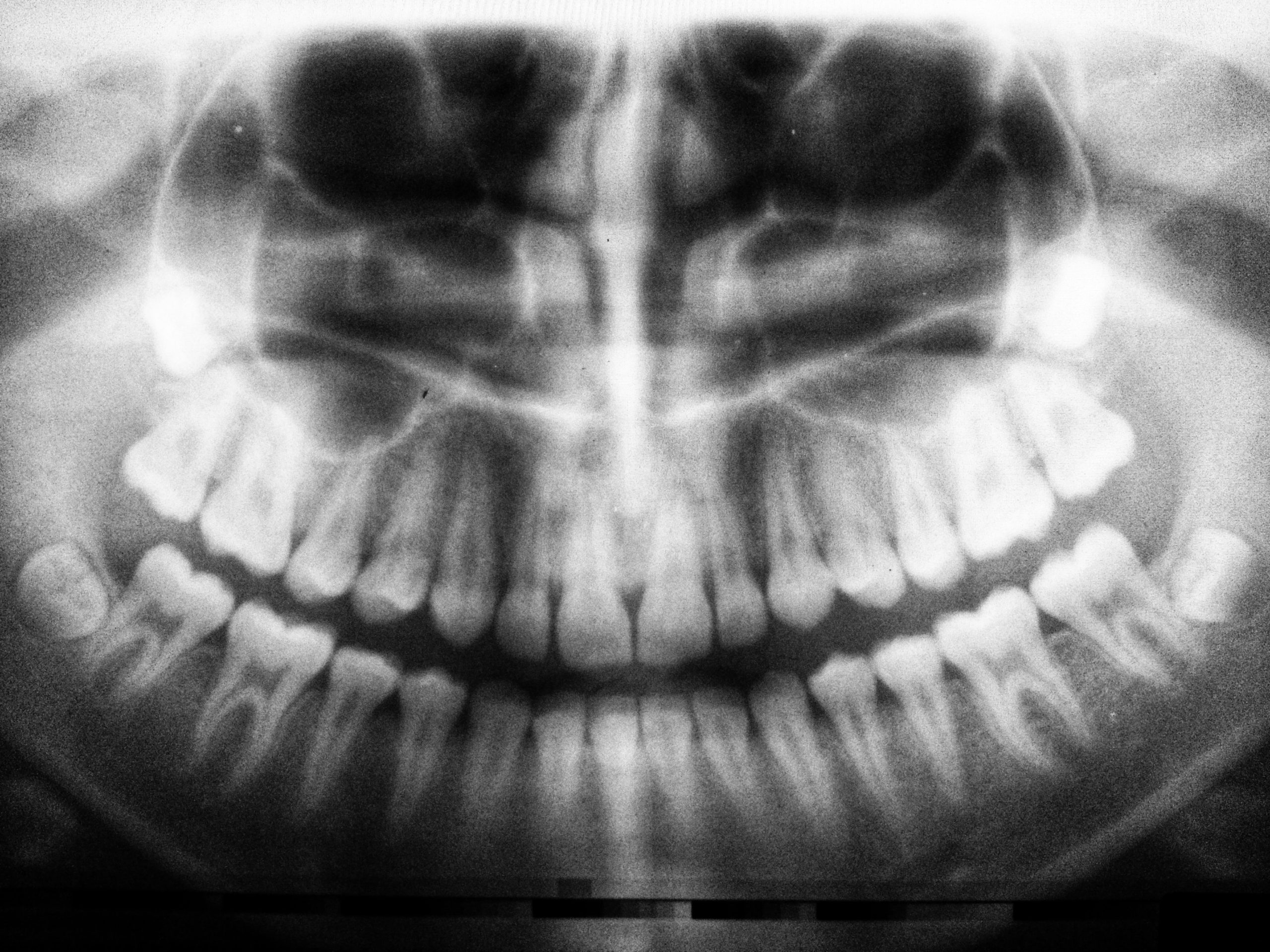 An x-ray image displaying unerupted wisdom teeth