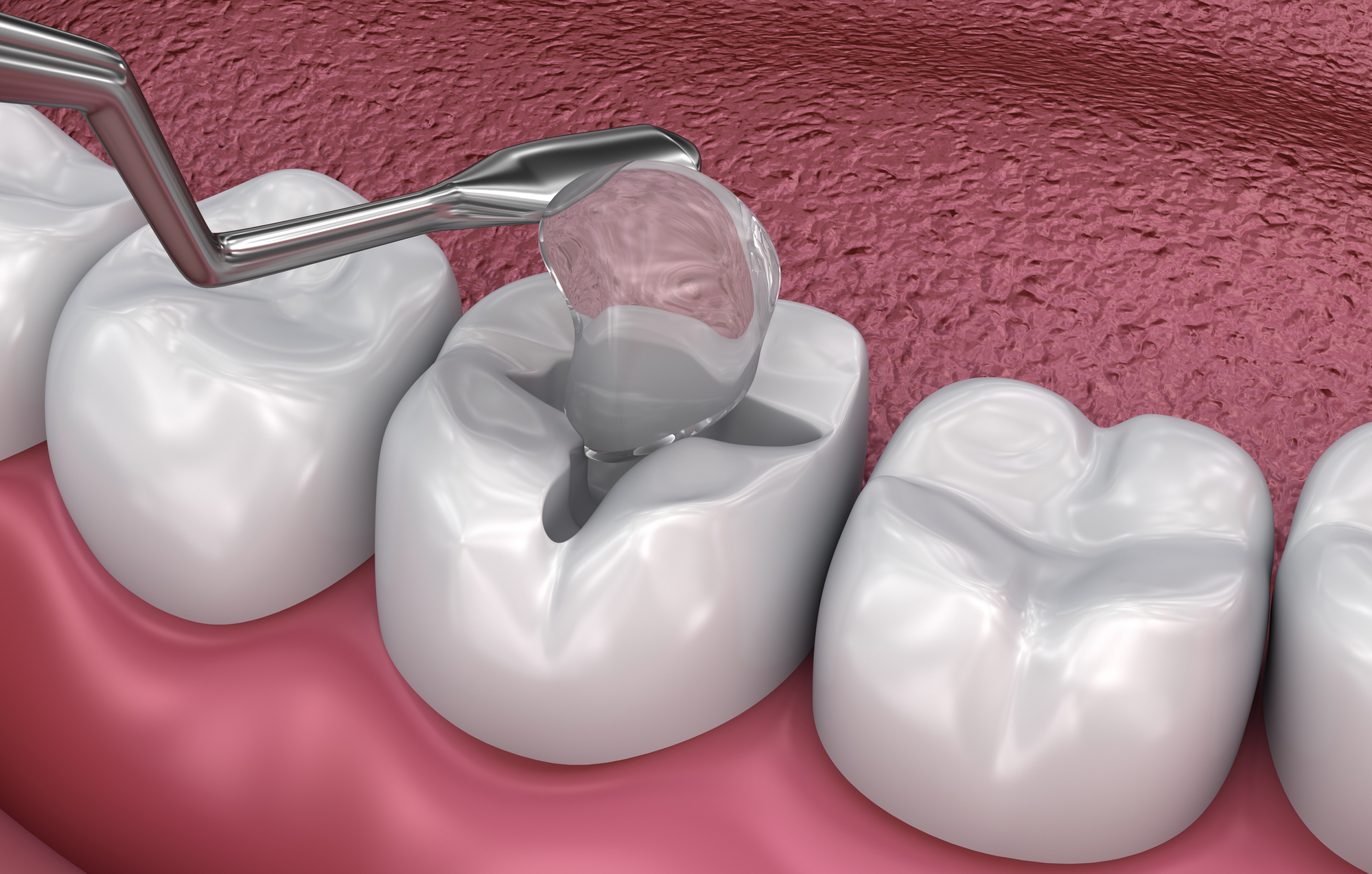 An illustration showing how dental fillings work