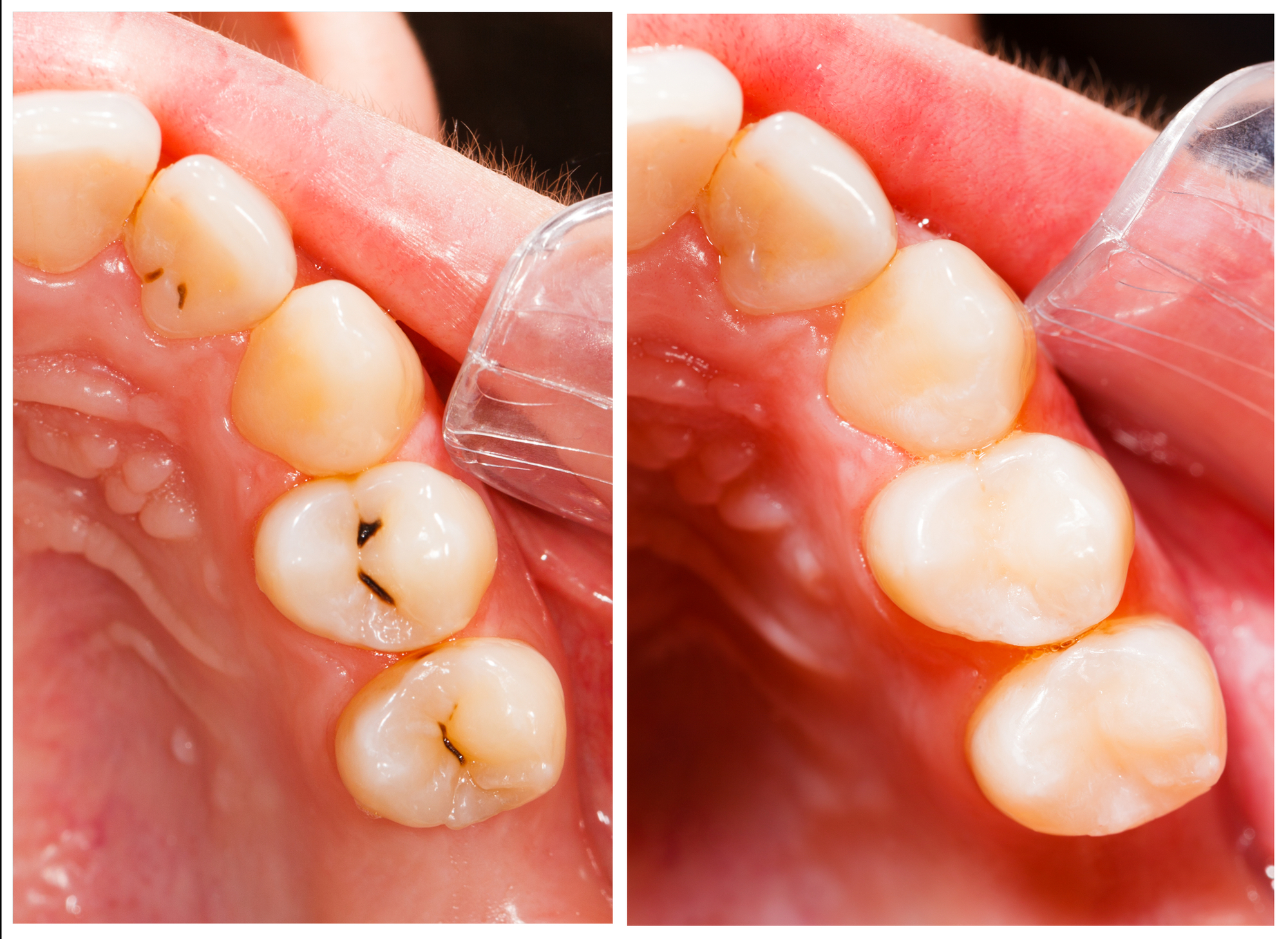Side-by-side comparison of teeth with cavities and teeth with teeth fillings in place.