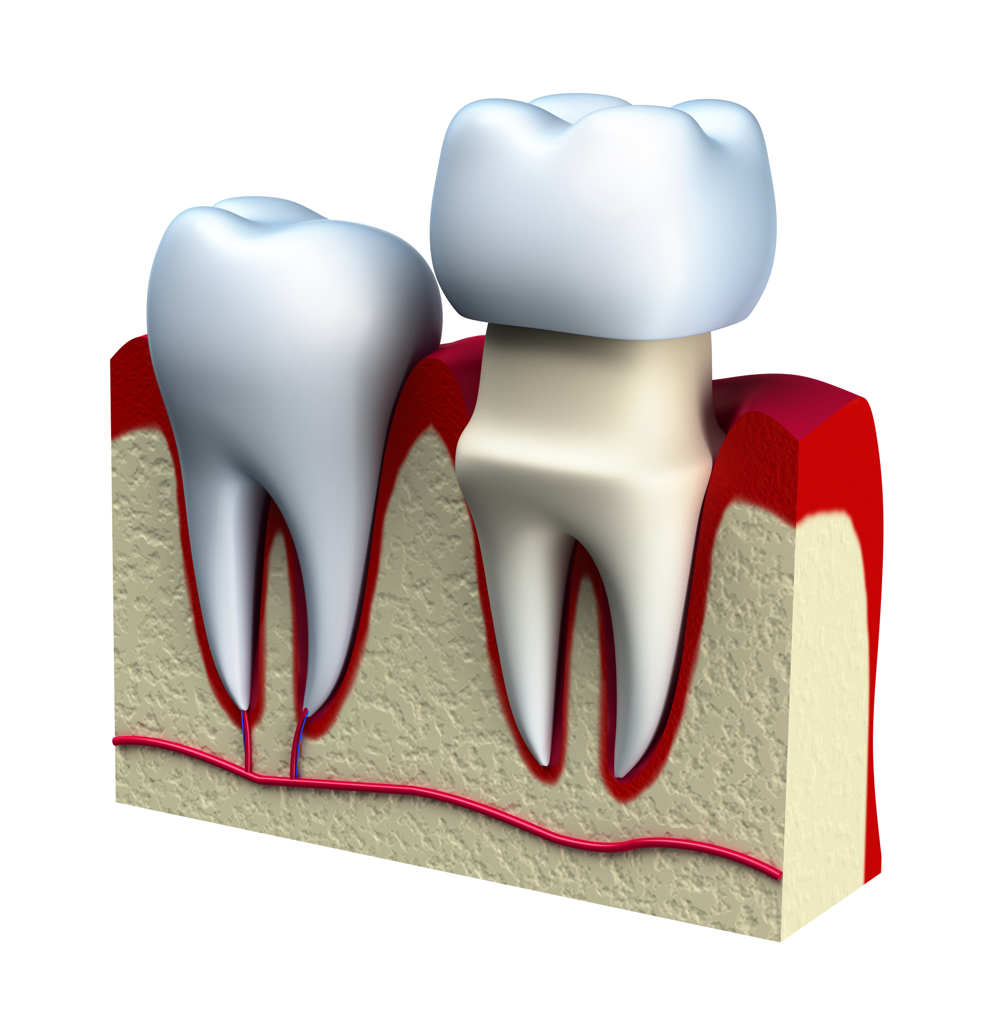 3D illustration of how dental crowns are placed on the teeth.