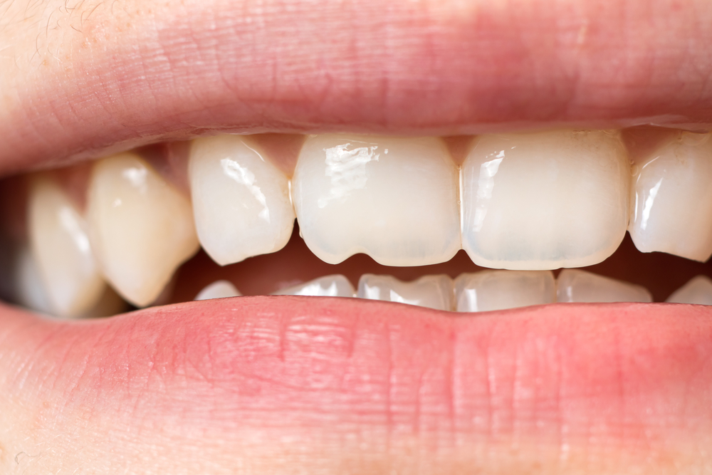 up close picture of woman's chipped tooth