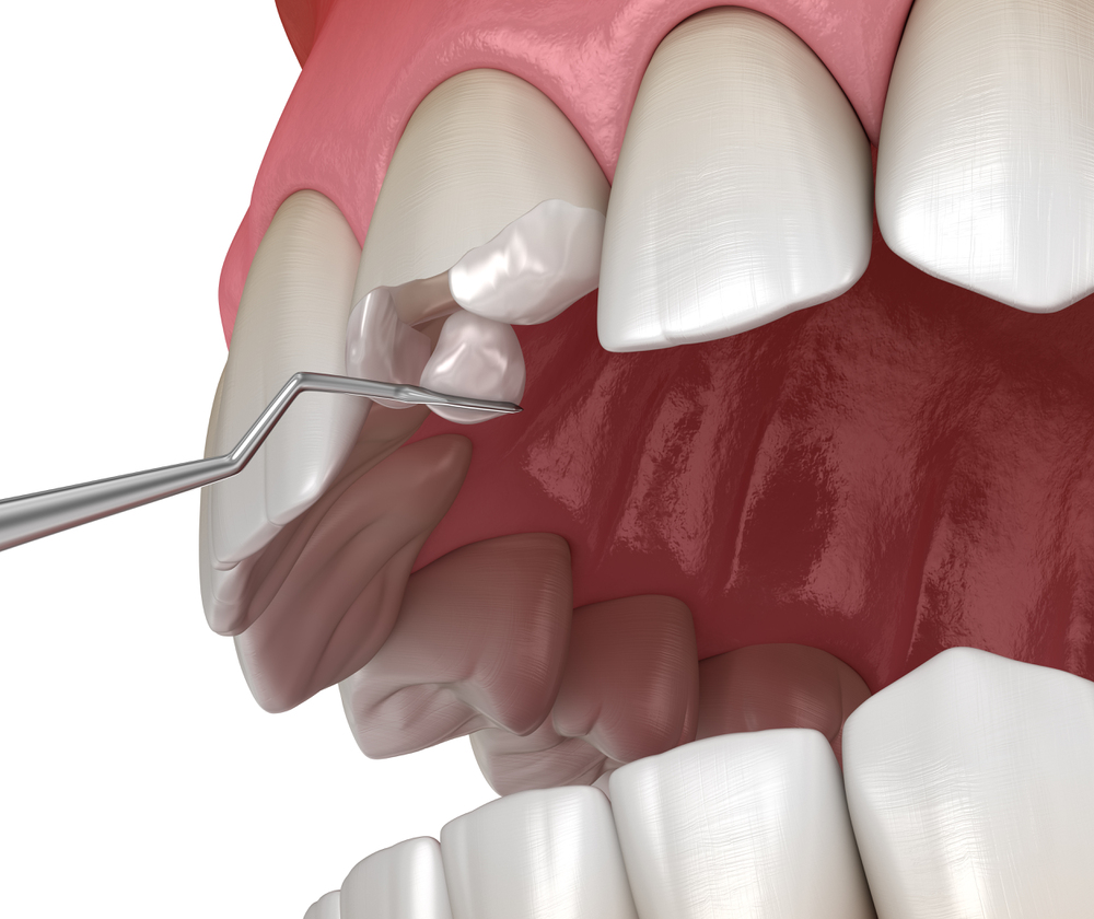 repairing a Broken tooth