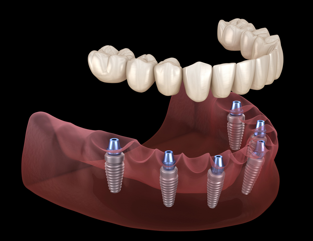 full set of dentures being placed on five dental implants in lower jaw