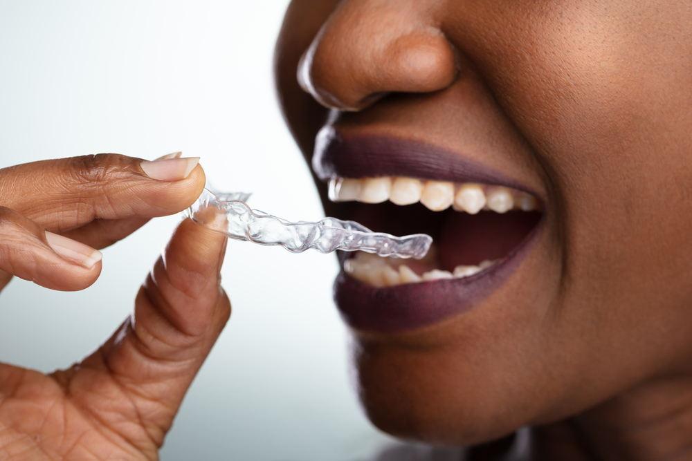 woman placing clear aligner on top teeth