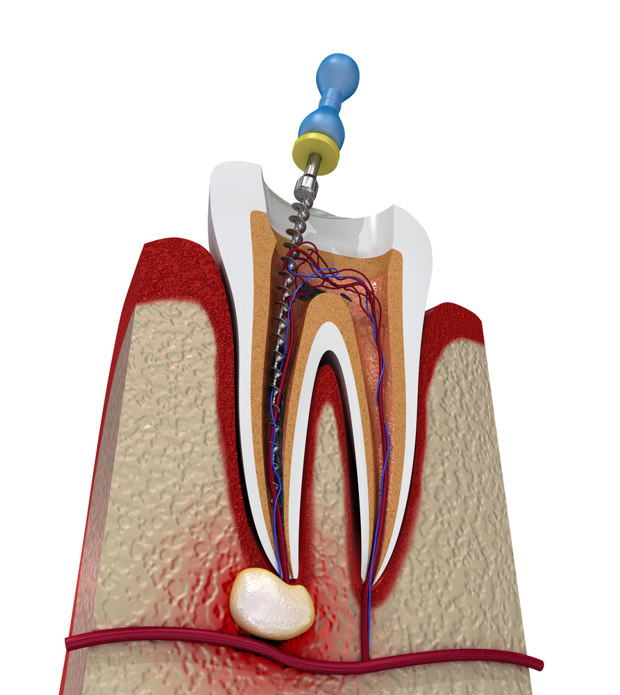 illustration of root canal on infected tooth