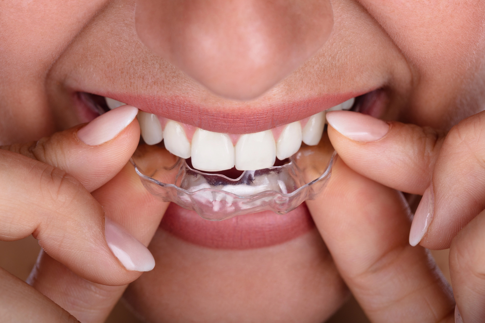 woman placing clear aligners in her mouth